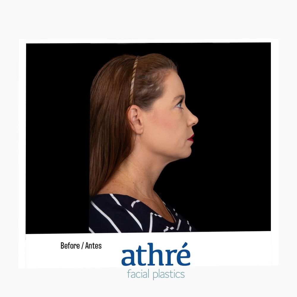 Facial Fat Transfer Before & After