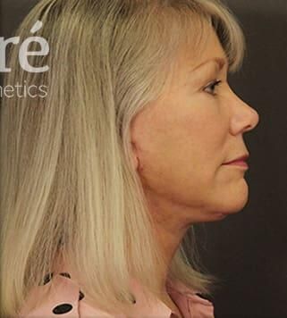 Brow Lift Before & After