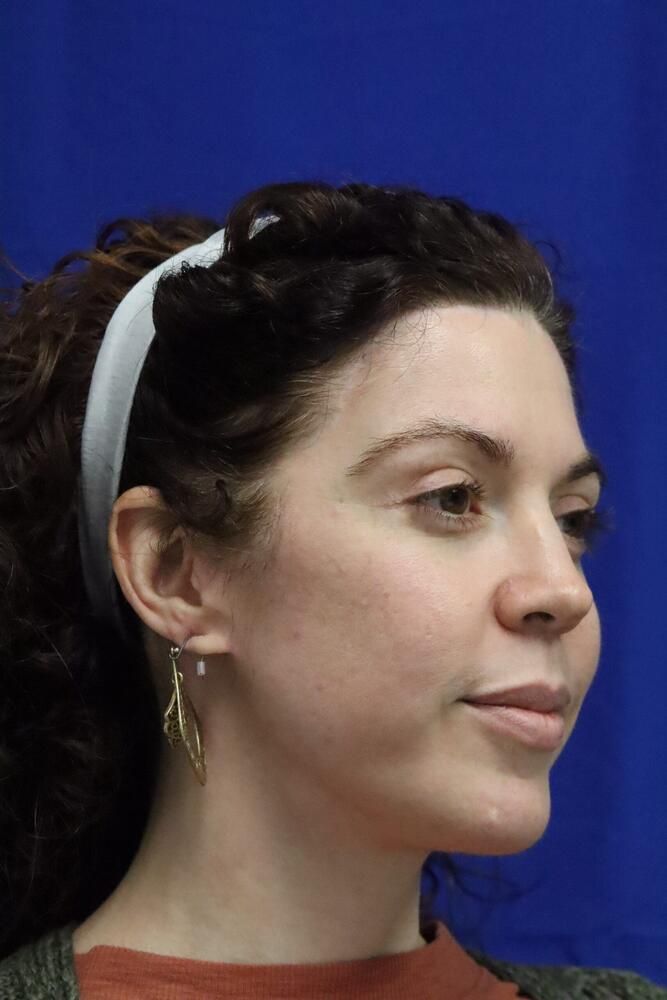 Brow Lift Before & After