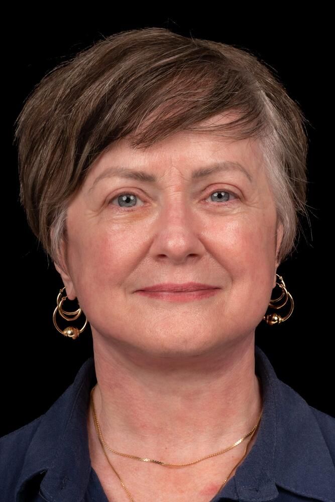 Brow Lift Before & After