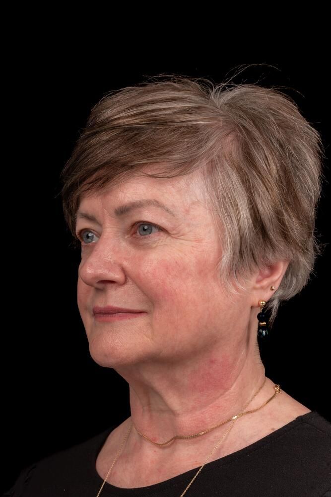 Brow Lift Before & After