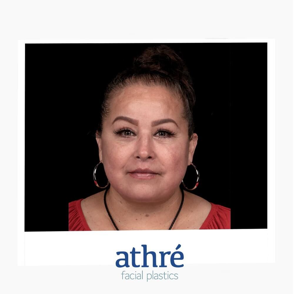 Brow Lift Before & After