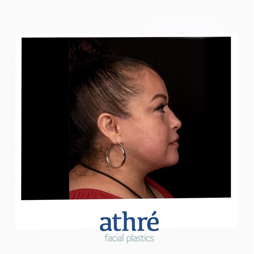 Brow Lift Before & After