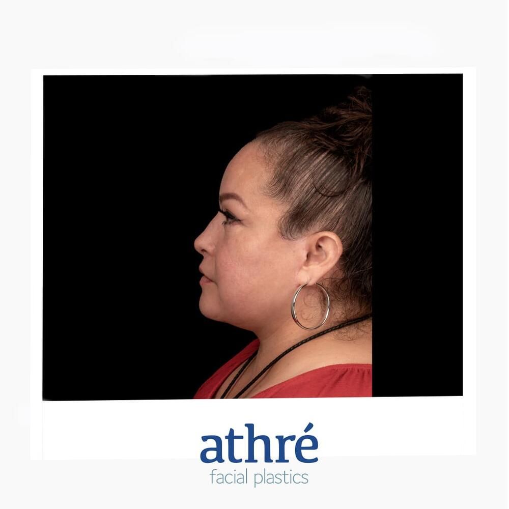 Brow Lift Before & After