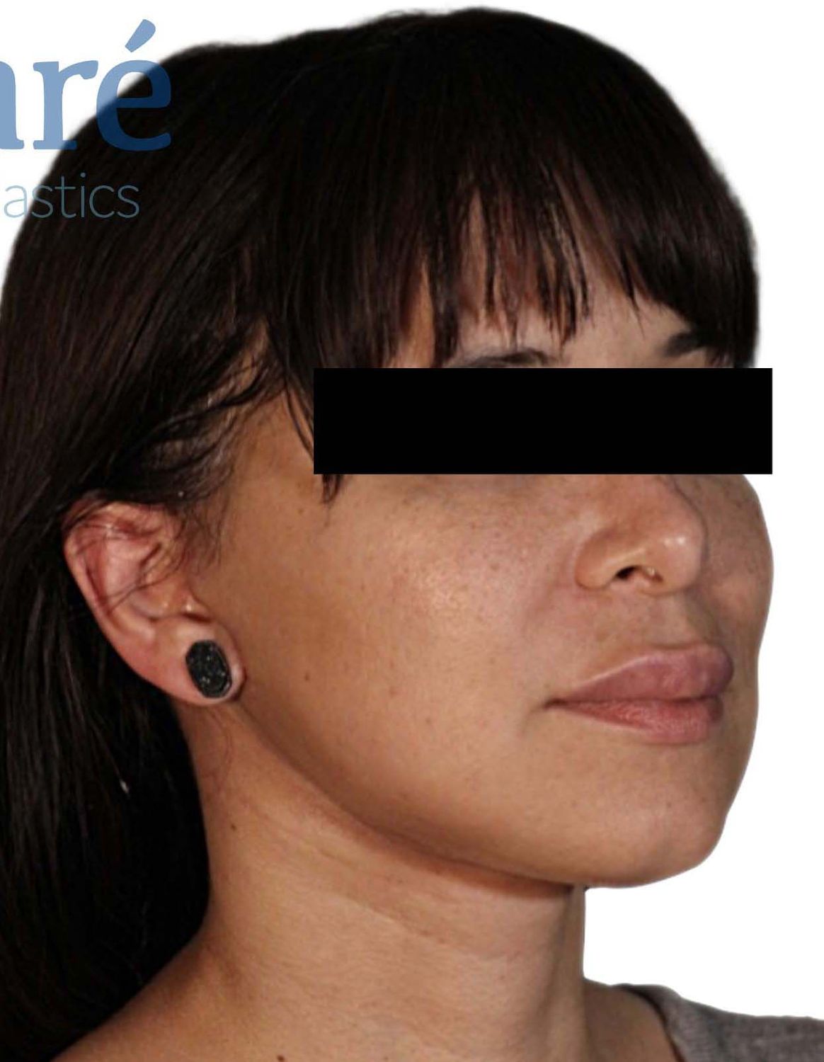 Lip Lift Before & After