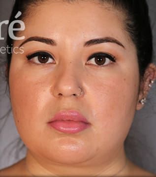 Lip Lift Before & After