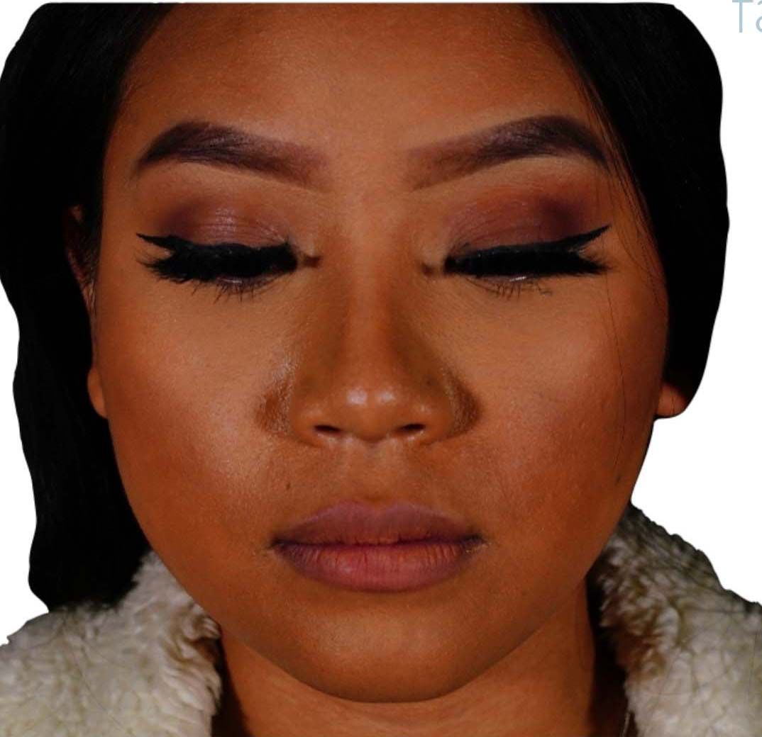 Lip Lift Before & After