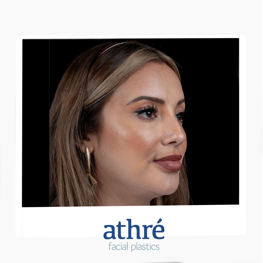 Lip Lift Before & After