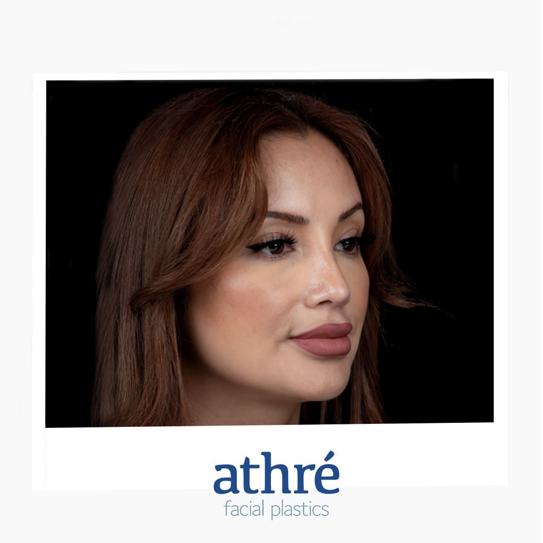 Lip Lift Before & After