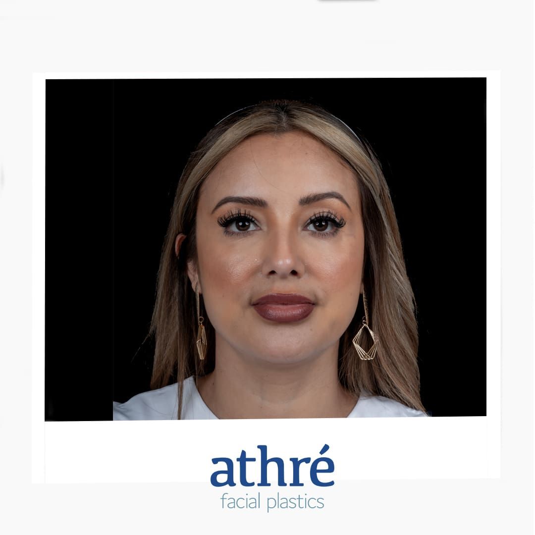 Lip Lift Before & After