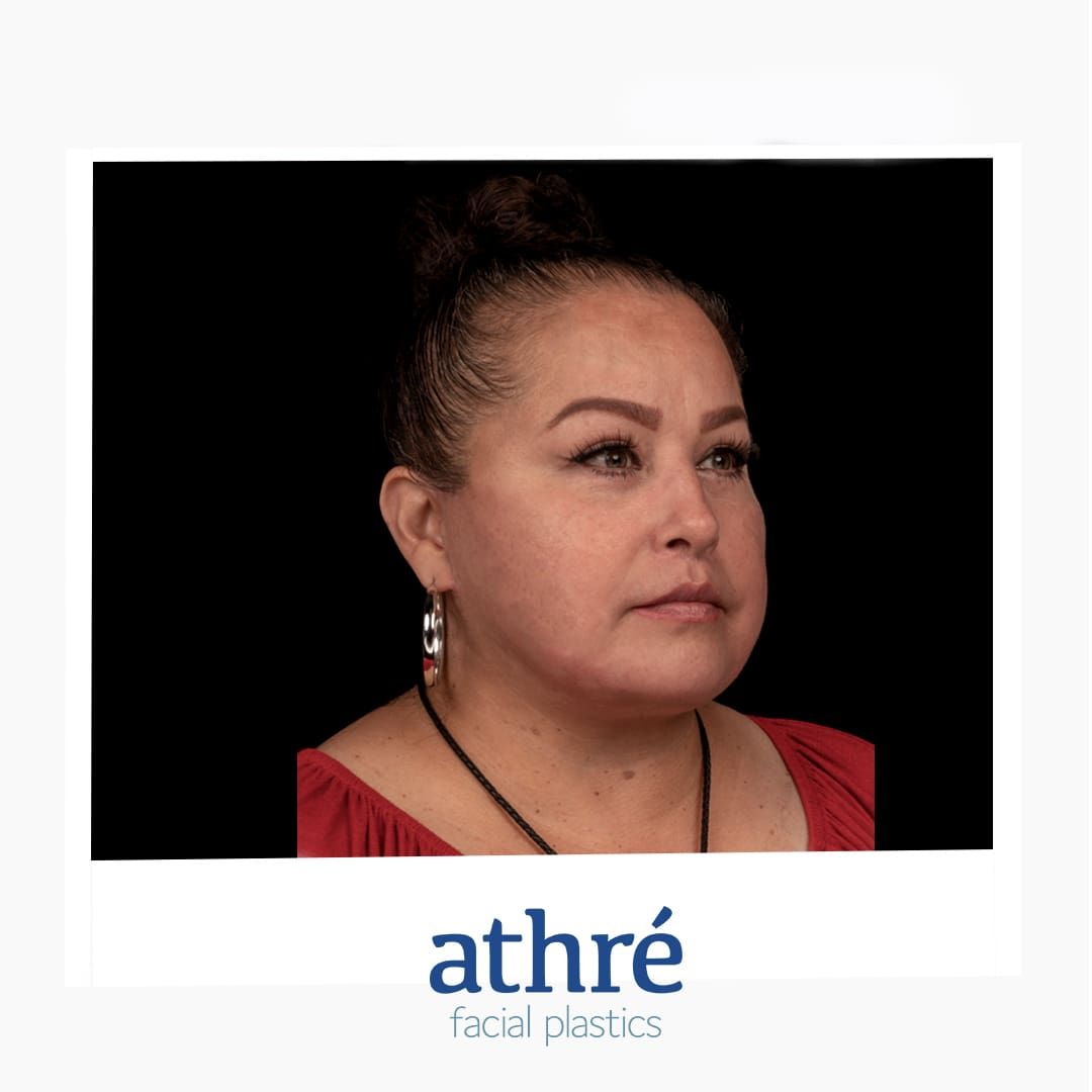 Lip Lift Before & After