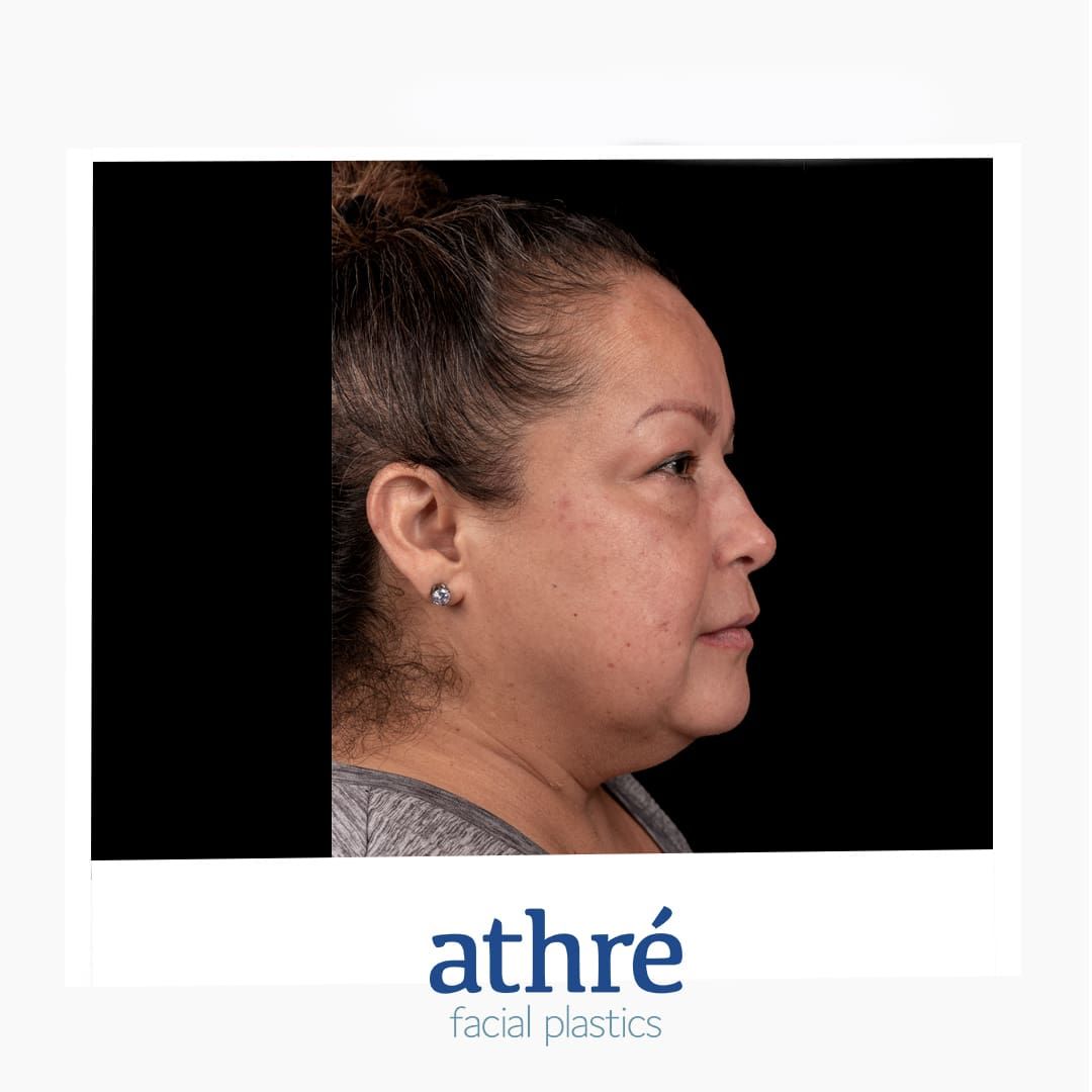 Lip Lift Before & After