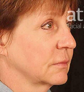 Skin Resurfacing Before & After