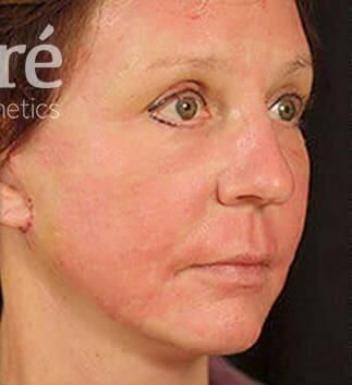 Skin Resurfacing Before & After
