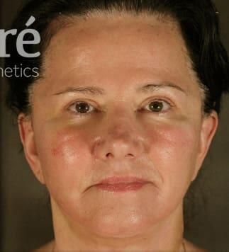 Skin Resurfacing Before & After