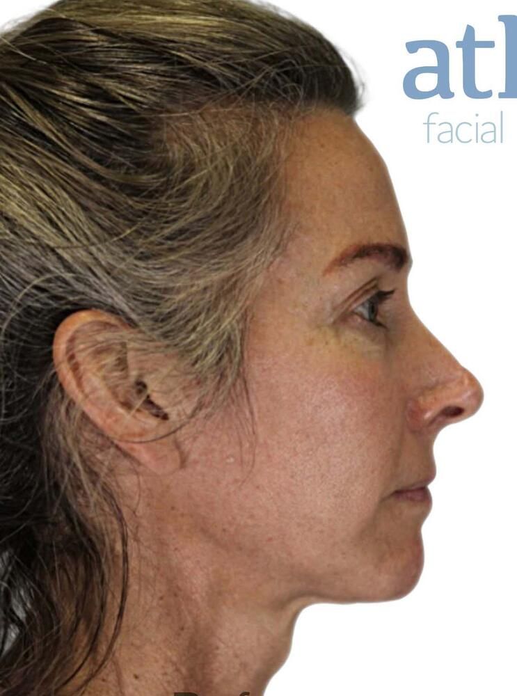 Skin Resurfacing Before & After