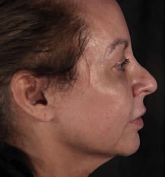 Skin Resurfacing Before & After