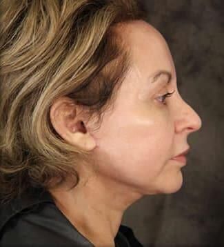 Skin Resurfacing Before & After
