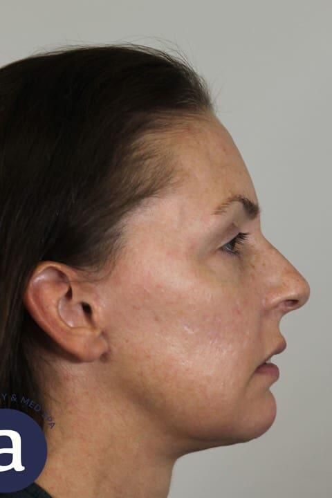 Skin Resurfacing Before & After