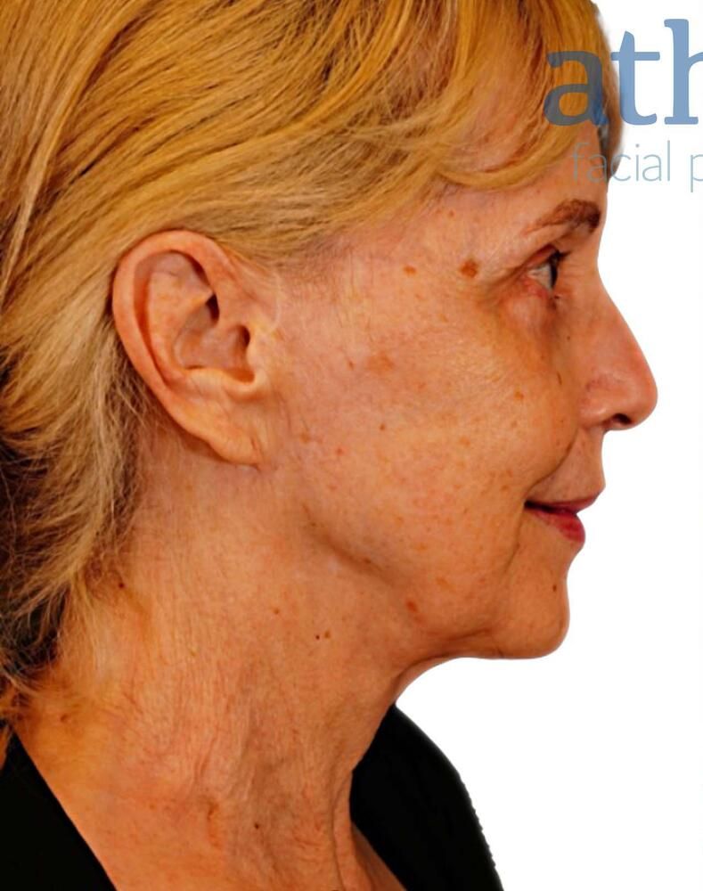 Skin Resurfacing Before & After