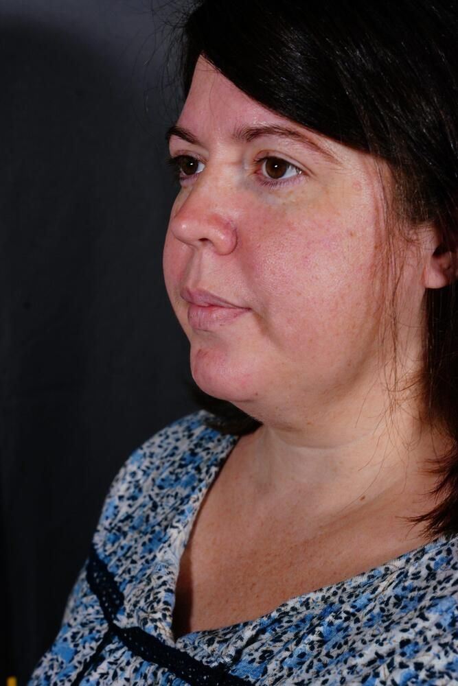 Skin Resurfacing Before & After