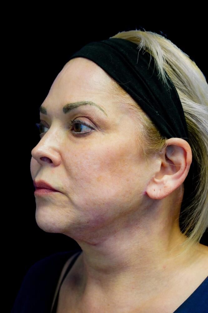 Skin Resurfacing Before & After