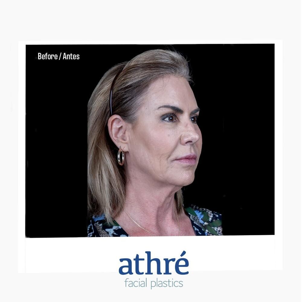 Skin Resurfacing Before & After