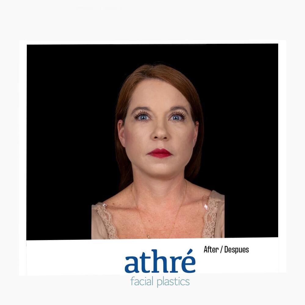 Skin Resurfacing Before & After