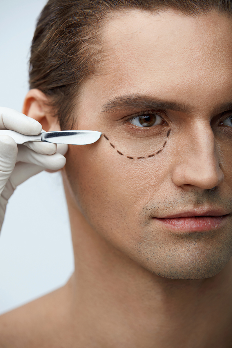 Plastic Surgery. Closeup Of Handsome Male Face With Black Marks On Skin Under Eye. Portrait Of Young Man With Lines Getting Plastic Operation On Eyelids, Facial Beauty Procedure. High Resolution