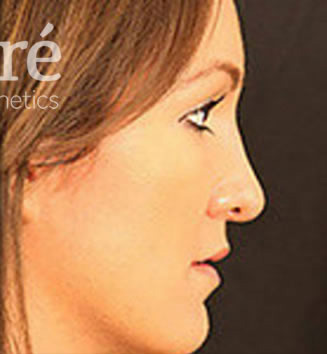 Rhinoplasty Patient Photo - Case 5610 - after view