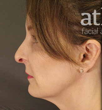 Revision Rhinoplasty Patient Photo - Case 5665 - before view-3