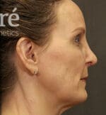 Revision Rhinoplasty - Case 5665 - After