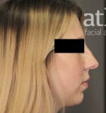 Revision Rhinoplasty - Case 5682 - Before