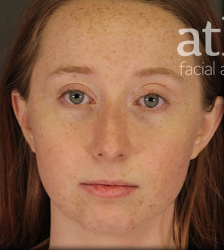 Rhinoplasty Patient Photo - Case 5719 - before view-2