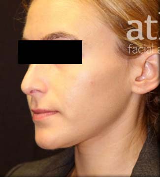 Rhinoplasty Patient Photo - Case 5780 - before view-2