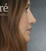 Revision Rhinoplasty - Case 5797 - After