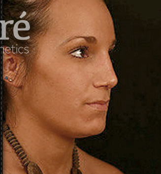 Rhinoplasty Patient Photo - Case 5839 - after view