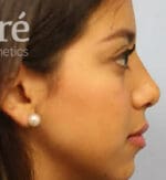 Revision Rhinoplasty - Case 5844 - After