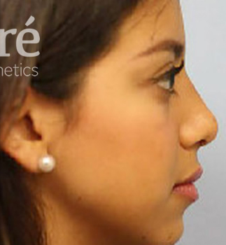 Revision Rhinoplasty Patient Photo - Case 5844 - after view