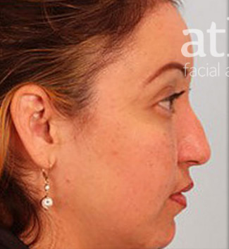 Rhinoplasty Patient Photo - Case 5864 - before view-