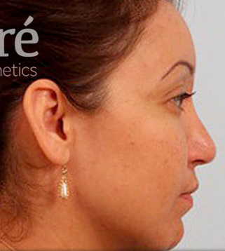 Rhinoplasty Patient Photo - Case 5864 - after view-0