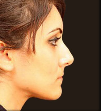 Rhinoplasty Patient Photo - Case 5923 - before view-