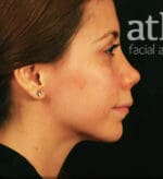Revision Rhinoplasty - Case 5986 - Before