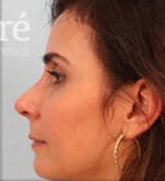 Revision Rhinoplasty - Case 6000 - After