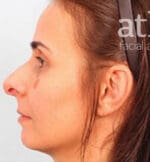 Revision Rhinoplasty - Case 6000 - Before