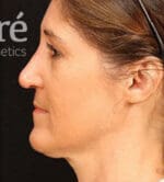 Revision Rhinoplasty - Case 6008 - After