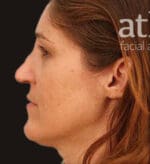 Revision Rhinoplasty - Case 6008 - Before