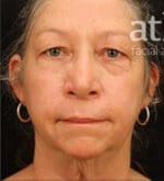 Eyelid Surgery - Case 6136 - Before