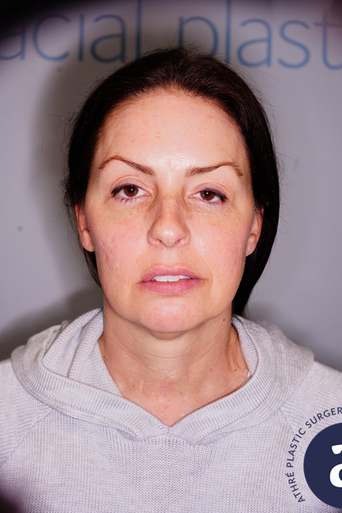 Eyelid Surgery Patient Photo - Case 6183 - before view-1