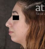 Chin Augmentation - Case 6295 - Before